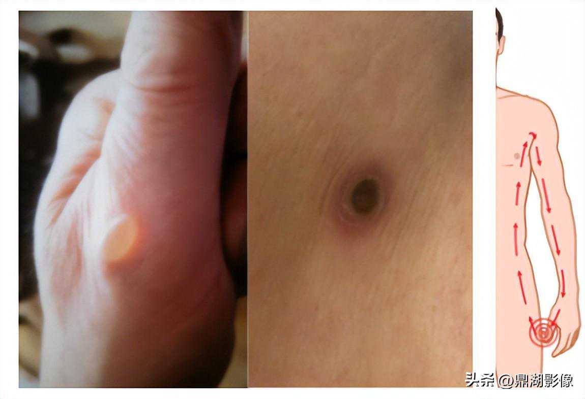 一定要当心MR灼伤！这些原因你要知道