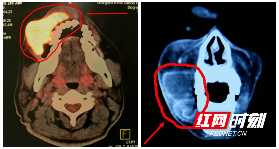晚期口腔癌患者半张脸都是肿瘤，湘雅专家创新技术换新颜